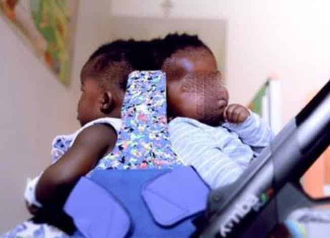 Conjoined Twins Separated Successfully In First-Of-Its-Kind Surgery (Photos)